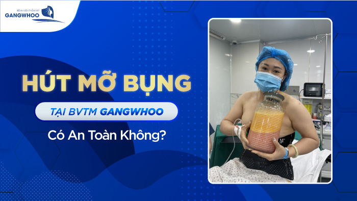 Hút Mỡ Bụng Tại BVTM Gangwhoo Có An Toàn Không?