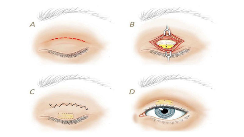 Tiến hành cắt mí Full tạo một đường rạch kéo dài từ góc mắt tới gần phần đuôi mắt