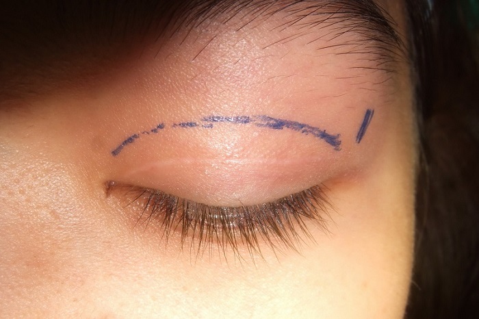 Phẫu thuật cắt mí được nhiều người lựa chọn, để mắt nhìn đẹp hơn