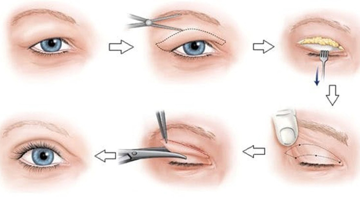 Vậy phẫu thuật cắt mí mắt là gì? Bôi thuốc gì sau khi cắt mí mắt 