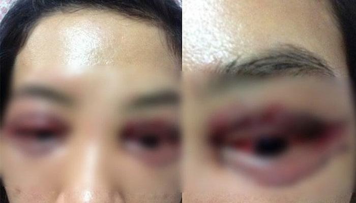 Rủi ro sau khi cắt mí mắt - các triệu chứng sau khi cắt mí mắt