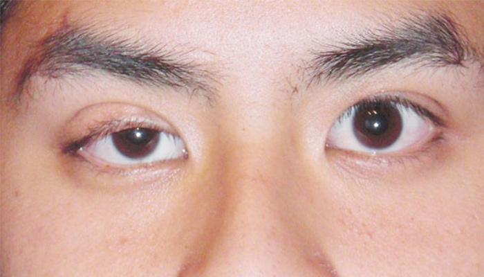 Biểu hiện cắt mí sai - các triệu chứng sau khi cắt mí mắt